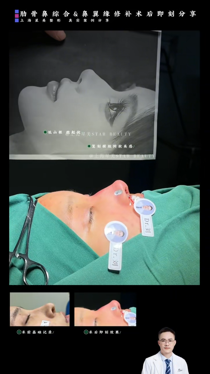 Costal bone nose synthesis + nose flange repair Kaagad na kaso pagkatapos ng operasyon: isang pinagsamang plano ng "nose tip support + nose flange reduction"