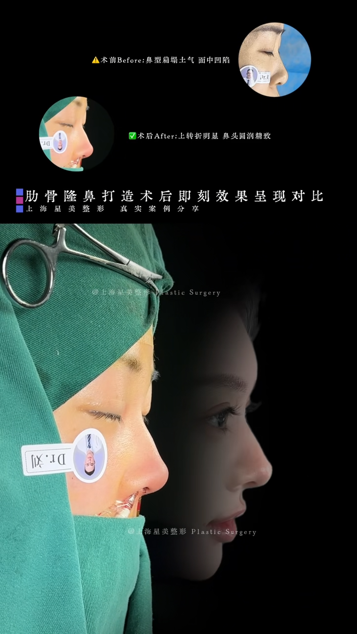Paghahambing ng agarang epekto pagkatapos ng rib rhinoplasty