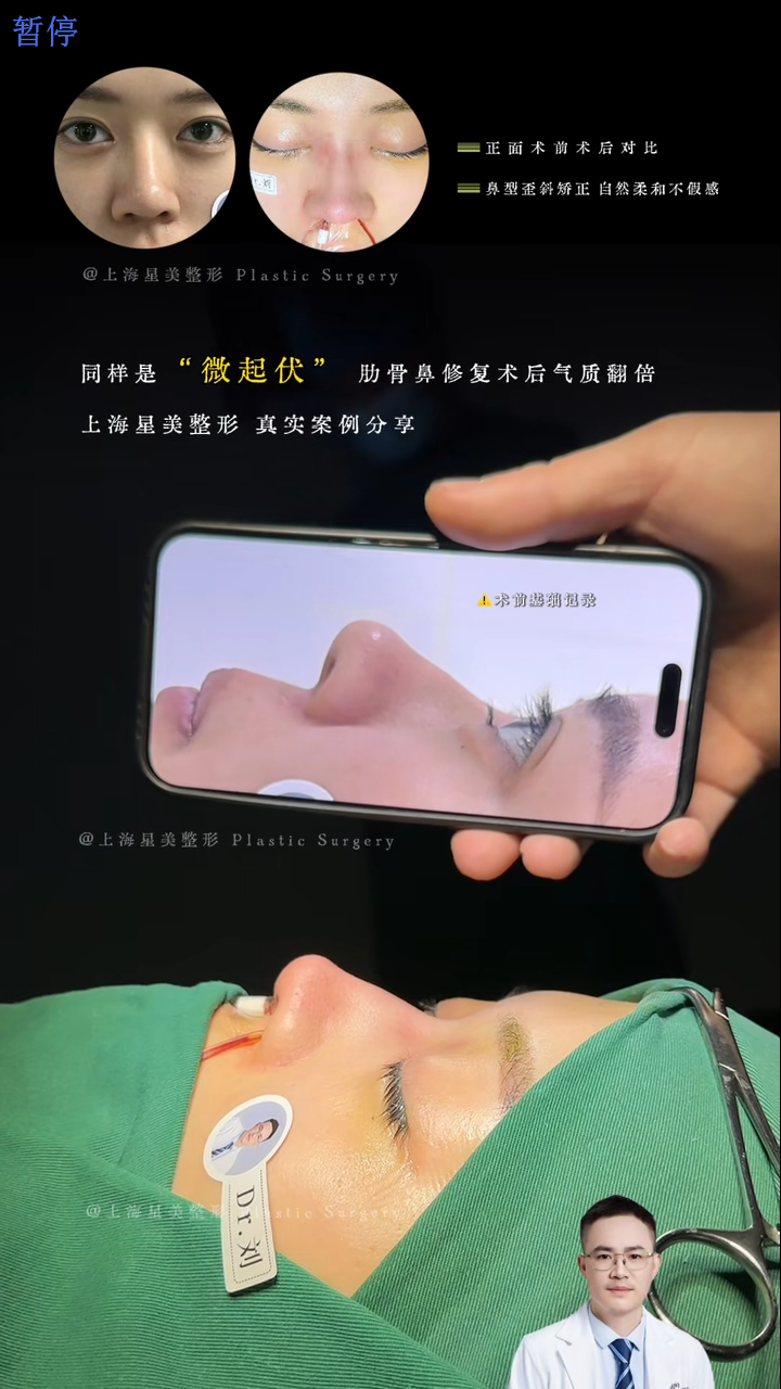 Bahagyang undulating rib nose repair