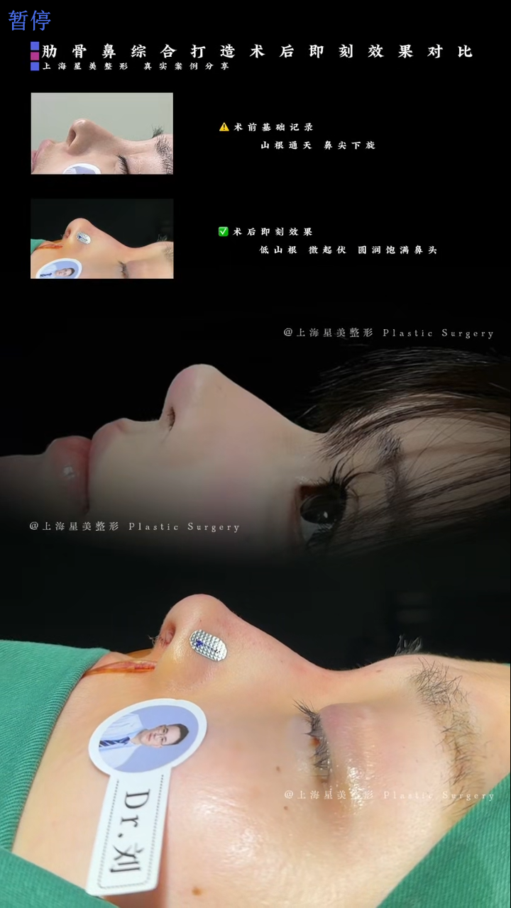 Agad na paghahambing pagkatapos ng costal bone nose synthesis